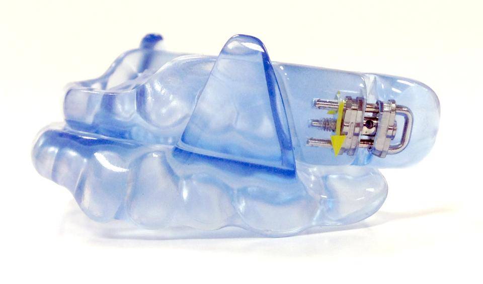 Continuous Open Airway Therapy SomnoDent