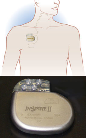 Inspire medical sleep apnea device