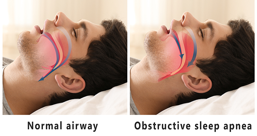 Normal airway and OSA airway