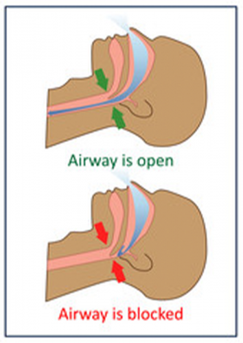 Blocked airway due to structural deformities